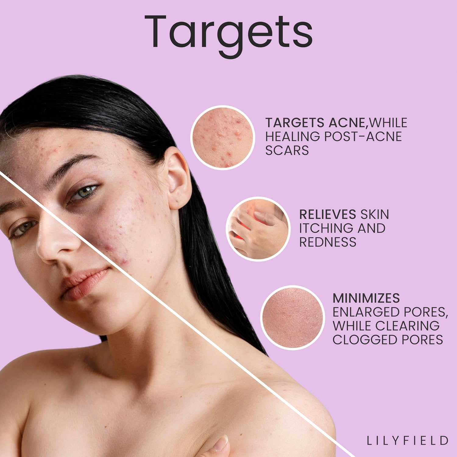 Glow Serum, Smoothen Acne, Pigmentation & Spots. Enlarged Pores, Uneven Skin Tone, Brighten, for Sensitive Skin, Korean Skin care, Makeupstashpk