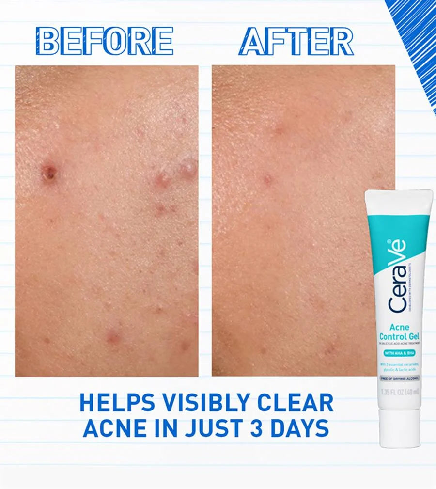 CeraVe Blemish Control Gel 40ml – Salicylic Acid Acne Treatment & Pore Refining Gel
