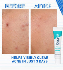 CeraVe Blemish Control Gel 40ml – Salicylic Acid Acne Treatment & Pore Refining Gel